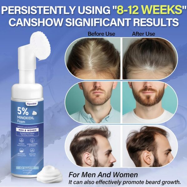 ماینوکسیدیل ۵٪ فوم نیگویدت | Nigwedete Advanced Regrowth | یک‌ماهه
