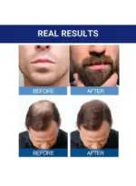درمان رویش مجدد مو 6 عددی | 6-Piece Minoxidil Hair Regrowth Treatment