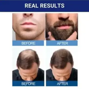 درمان رویش مجدد مو 6 عددی | 6-Piece Minoxidil Hair Regrowth Treatment