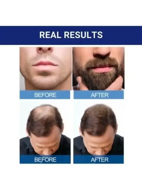 درمان رویش مجدد مو 6 عددی | 6-Piece Minoxidil Hair Regrowth Treatment